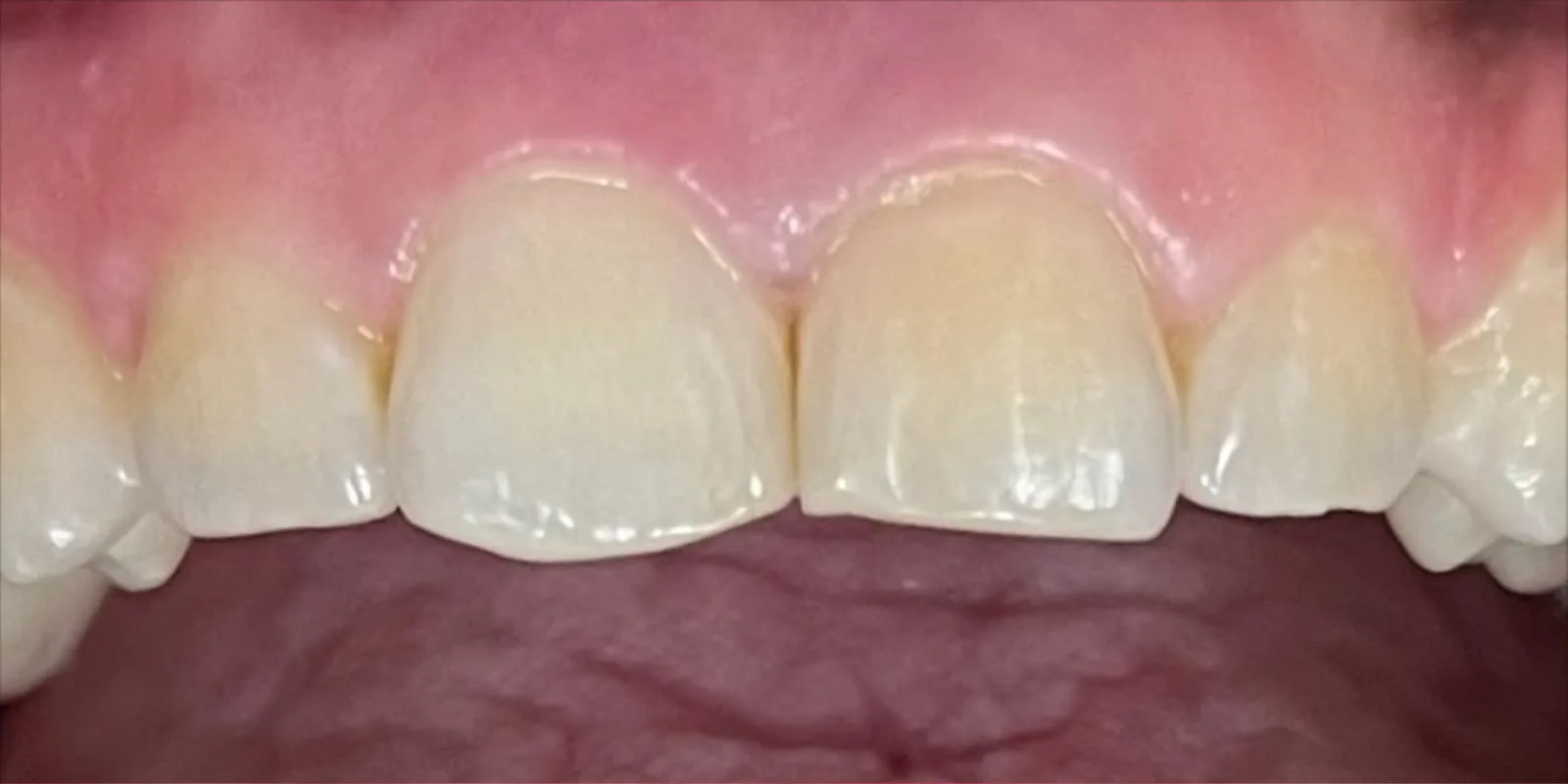 After: the same patient's upper front teeth with healthy pink gums