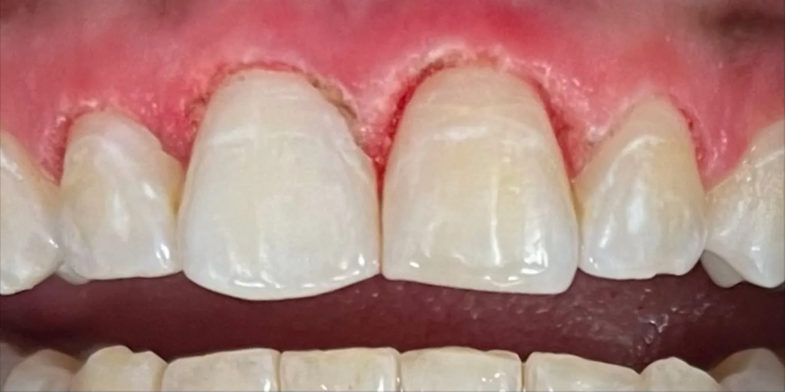Before: a patient's upper front teeth with red, irritated gums along the gum line